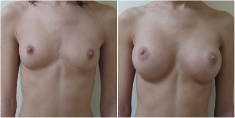 Augmentation mammaire - Dr Pascal Chantereau
