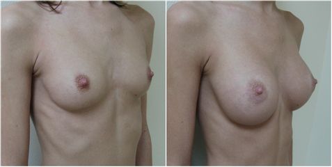 Augmentation mammaire - Dr Pascal Chantereau