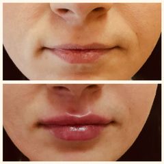 Augmentation des lèvres - Dr Laura Enjary