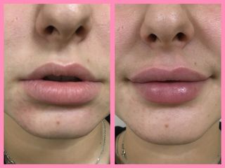Augmentation des lèvres - Dr Laura Enjary