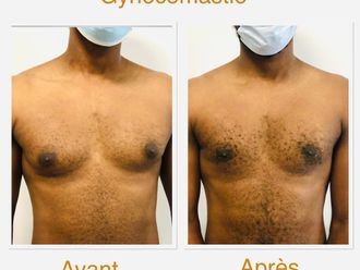 Gynécomastie avant et après - 843693