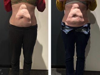 Cryolipolyse avant et après - 877136