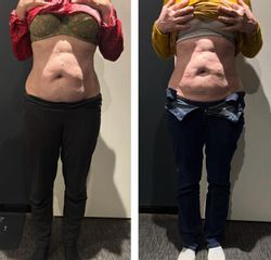 Cryolipolyse My Big Bang