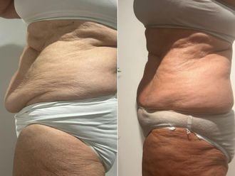 Cryolipolyse avant et après - 877137