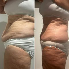 Cryolipolyse My Big Bang