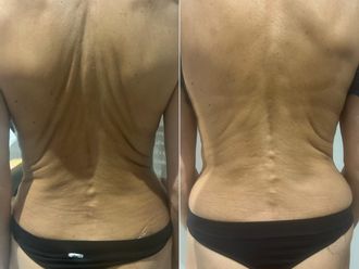 Radiofréquence avant et après - 877138