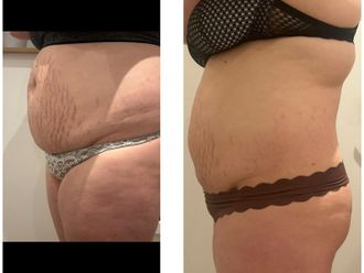 Cryolipolyse avant et après - 877139