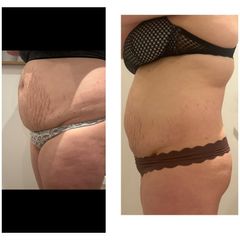 Cryolipolyse My Big Bang