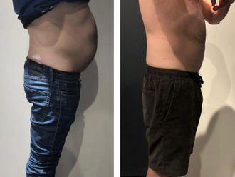 Cryolipolyse avant et après - 877140