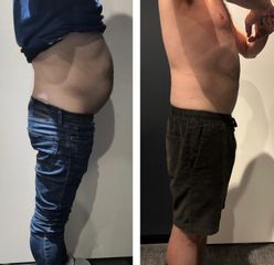 Cryoplipolyse My Big Bang