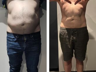 Cryolipolyse avant et après - 877141