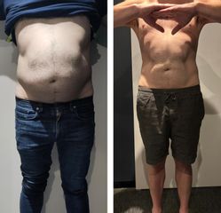 Cryoplipolyse My Big Bang