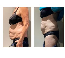 Cryolipolyse My Big Bang