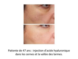 Acide Hyaluronique - 623891