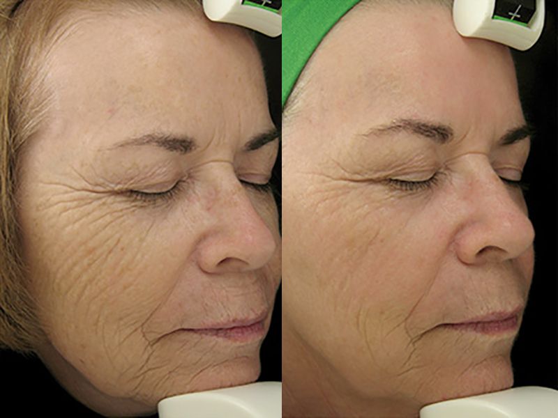 Traitement laser Avant et après Multiesthetique.fr Multiesthetique.fr