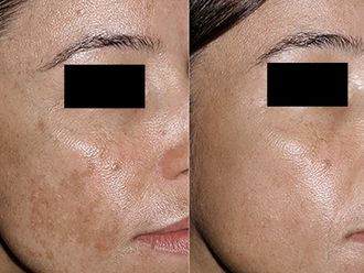 Peeling - 634677