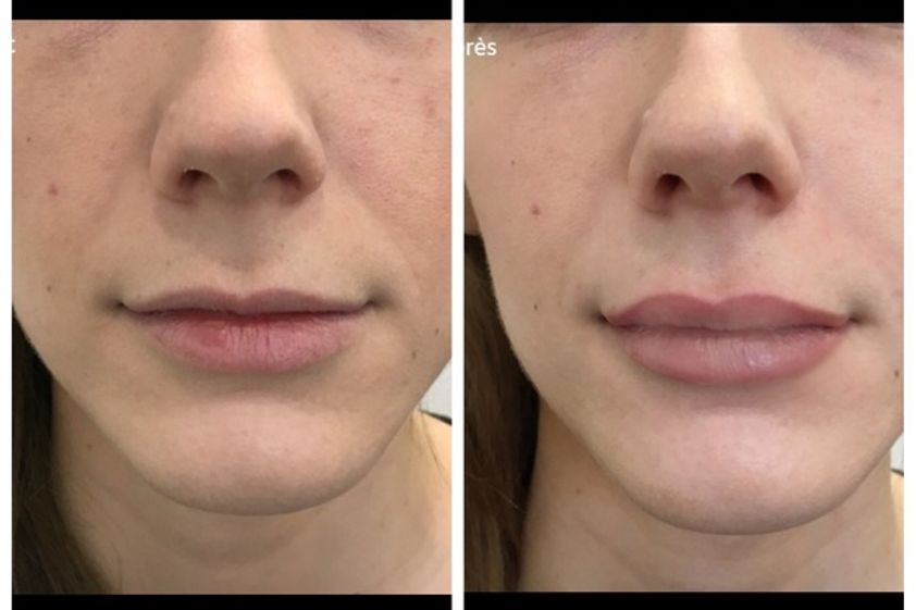 Augmentation des lèvres avant et après - 599025
