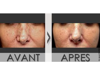 Avant après Rhinoplastie médicale