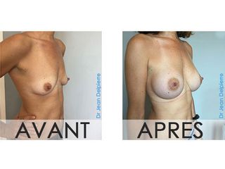 Avant après protheses anatomiques