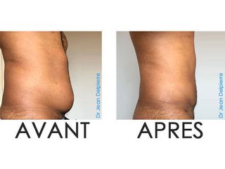 Avant après liposuccion abdominale homme