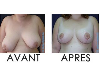 Avant après réduction mammaire