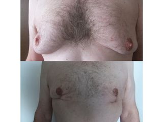Gynécomastie - Dr Fabrice Poirier