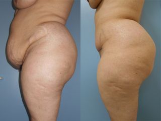 Abdominoplastie - Dr Fabrice Poirier