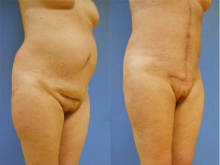 Abdominoplastie - Dr Fabrice Poirier