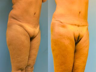 Abdominoplastie - Dr Fabrice Poirier