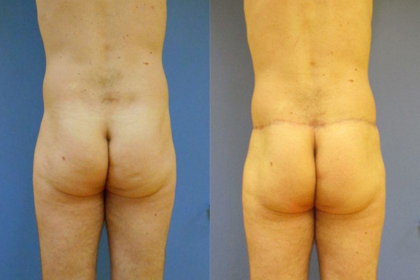 Chirurgie des fesses avant et après - 740841