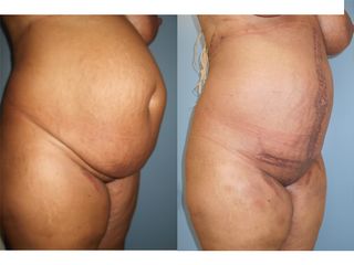 Abdominoplastie - Dr Fabrice Poirier