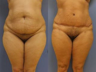 Abdominoplastie - Dr Fabrice Poirier
