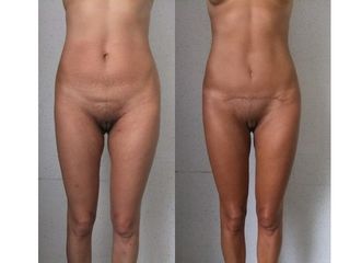 Abdominoplastie - Dr Fabrice Poirier
