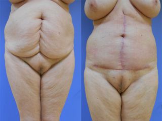 Abdominoplastie - Dr Fabrice Poirier