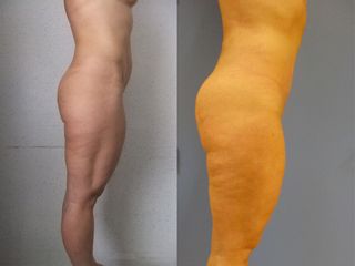 Chirurgie des fesses - Dr Fabrice Poirier