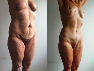 Liposuccion - Dr Fabrice Poirier