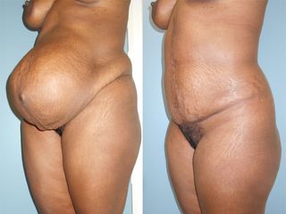 Abdominoplastie - Dr Fabrice Poirier