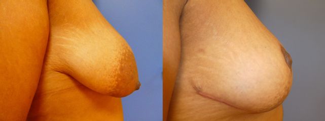 Mastopexie - Dr Fabrice Poirier