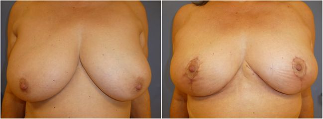 Mastopexie - Dr Fabrice Poirier