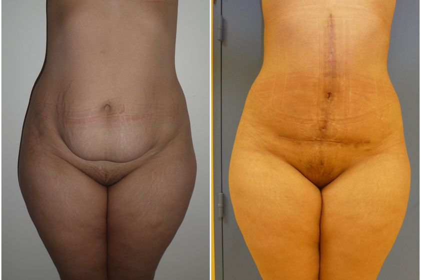Abdominoplastie avant et après - 828380