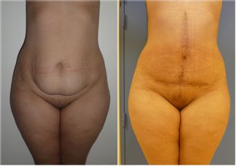 Abdominoplastie - Dr Fabrice Poirier