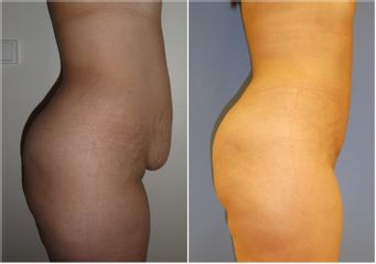 Abdominoplastie - Dr Fabrice Poirier