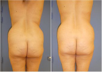 Abdominoplastie - Dr Fabrice Poirier