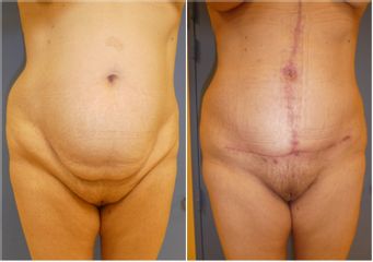 Abdominoplastie - Dr Fabrice Poirier