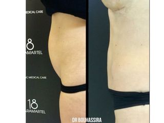 Avant après Liposuccion
