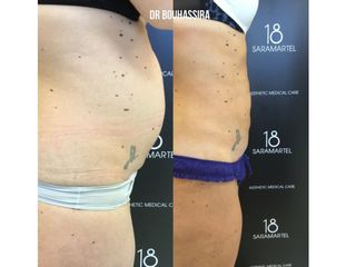 Avant après Liposuccion
