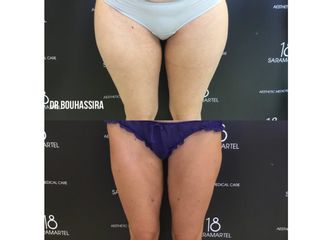 Avant après Liposuccion
