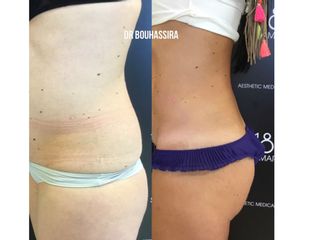 Avant après Liposuccion