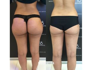 Avant après Liposuccion