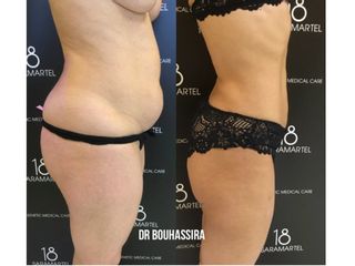 Avant après Liposuccion